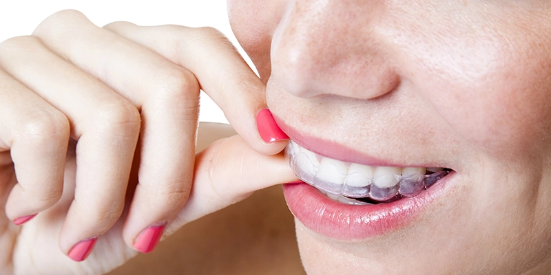 Benefits of Night Mouth Guards
