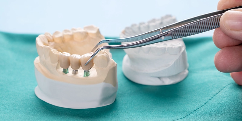Dental Bridges in Boca Raton, FL