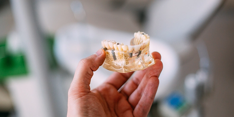 The Dental Implant Process