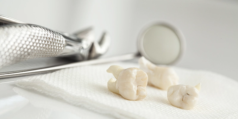 Tooth Extractions in Boca Raton, FL